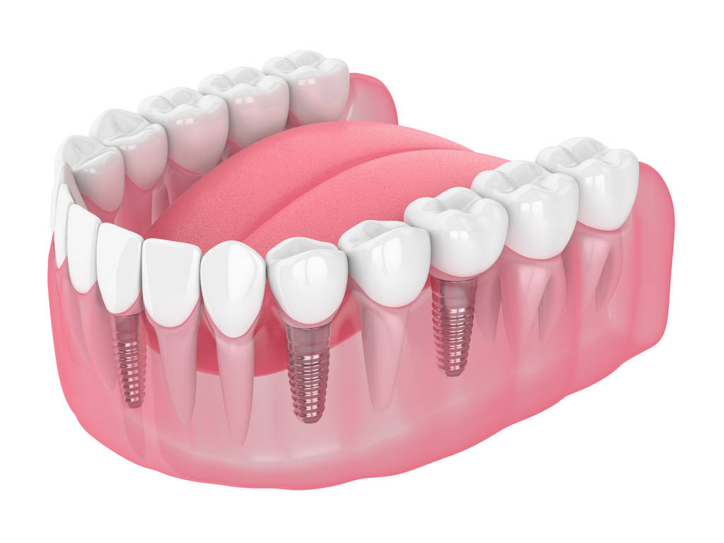 Dental implants in Perth WA